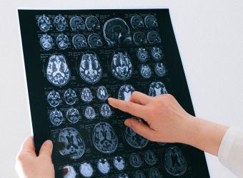 مناطق دماغية تتضرّر من ضغط الدم