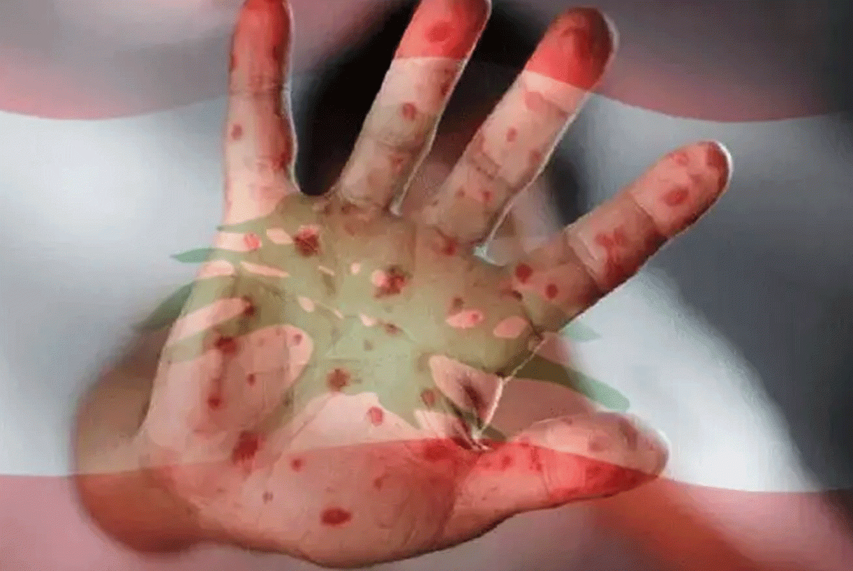 "تجمع الأطباء" و"الديمقراطي": للتحقّق من وجود جدري القرود